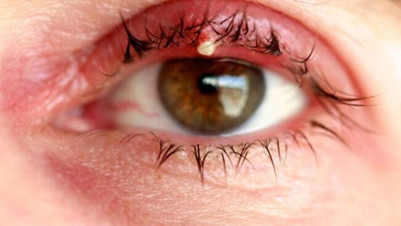 Geçmeyen Arpacık Göz Bozukluğu İşareti Olabilir