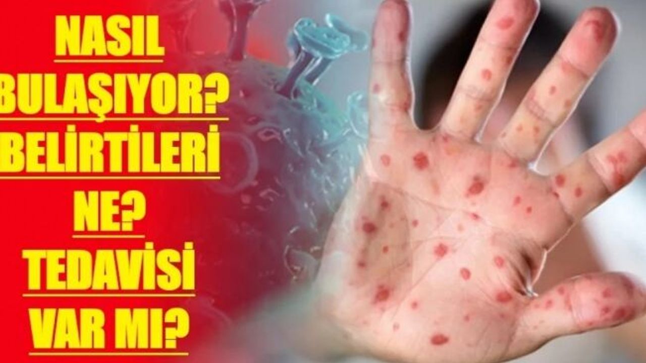 Mpox (Maymun Çiçeği) hastalığı hakkında bilinmesi gerekenler neler!