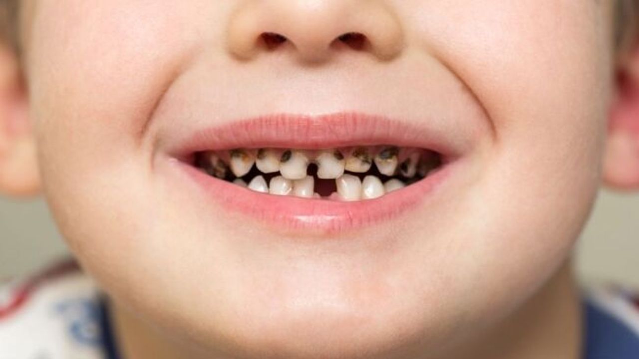 875 Bin çocuğun kalıcı dişlerinde çürük tehlikesi var