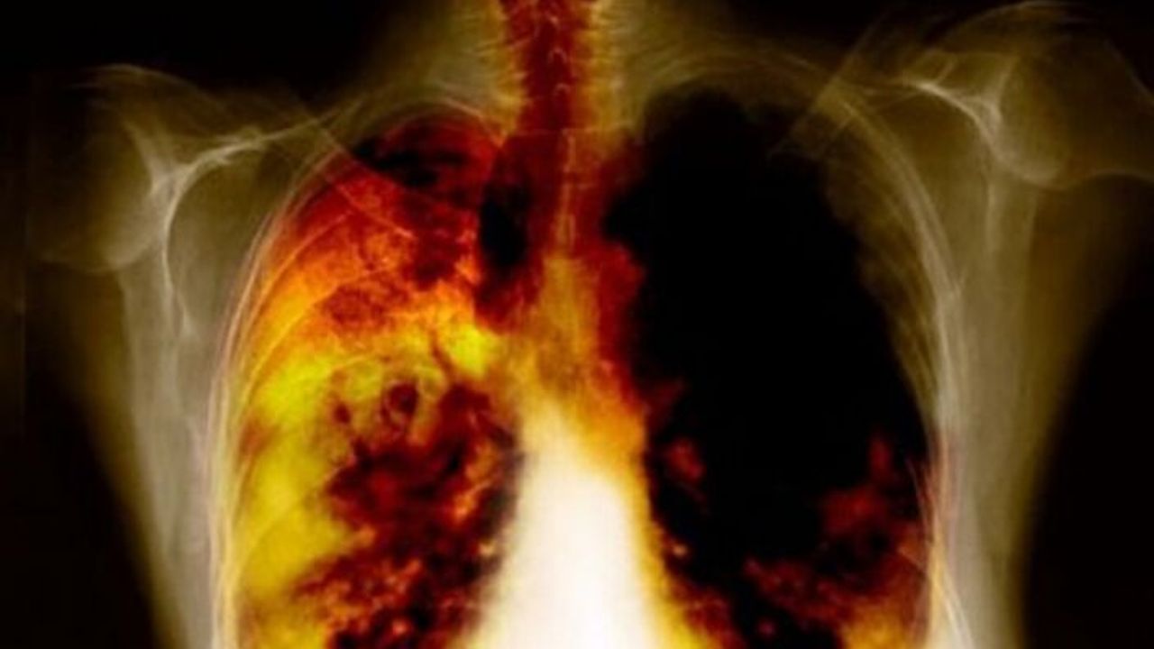 KOAH’ta erken tanı basit bir test ile mümkün