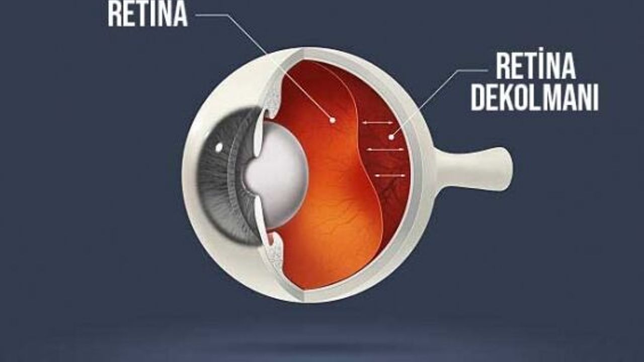 Retina dekolmanı körlüğe neden olabilir