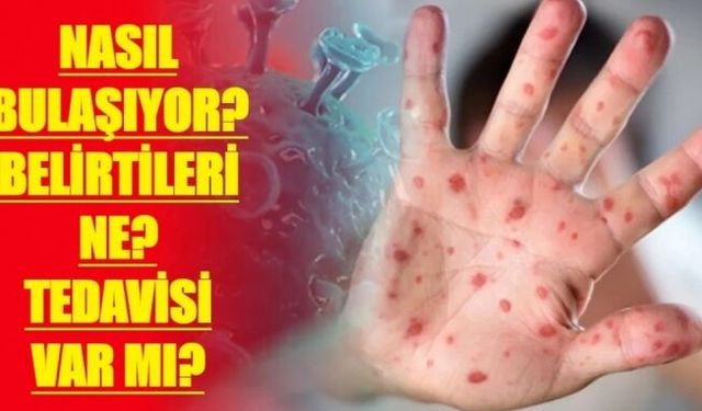 Mpox (Maymun Çiçeği) hastalığı hakkında bilinmesi gerekenler neler!