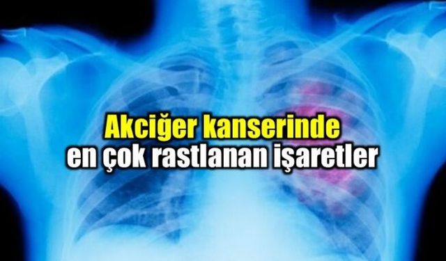 Akciğer Kanserine yakalanan 41 bin kişiden biri siz olmayın