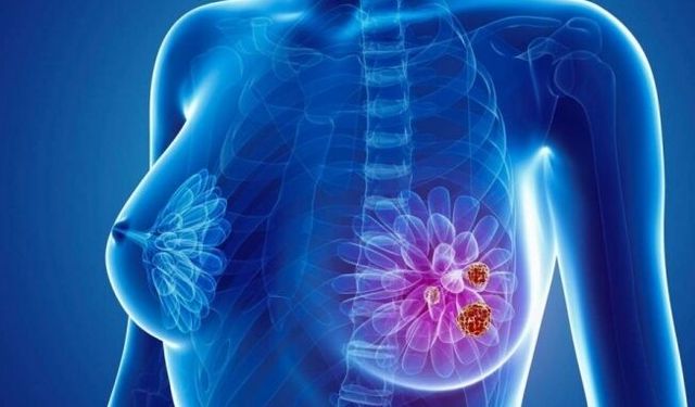 Meme kanserinde doğru bilinen yanlışlar